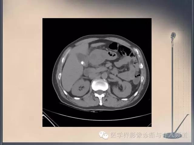 【病例】你以为这是肿瘤，其实这是鱼刺引发的“血案”！