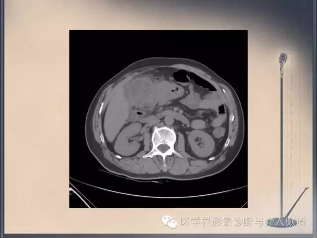 【病例】你以为这是肿瘤，其实这是鱼刺引发的“血案”！