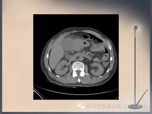 【病例】你以为这是肿瘤，其实这是鱼刺引发的“血案”！