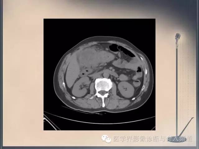 【病例】你以为这是肿瘤，其实这是鱼刺引发的“血案”！