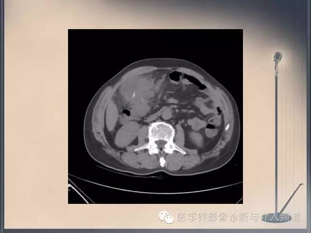【病例】你以为这是肿瘤，其实这是鱼刺引发的“血案”！