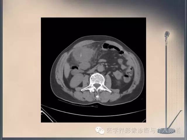 【病例】你以为这是肿瘤，其实这是鱼刺引发的“血案”！