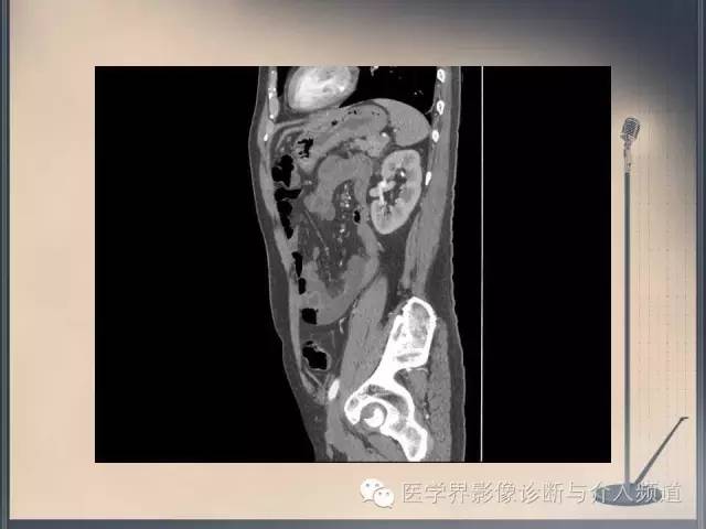 【病例】你以为这是肿瘤，其实这是鱼刺引发的“血案”！
