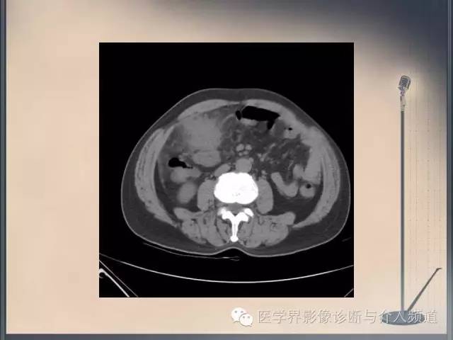 【病例】你以为这是肿瘤，其实这是鱼刺引发的“血案”！