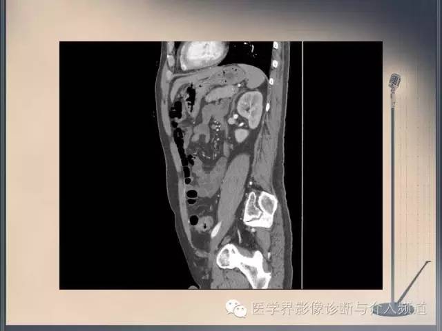 【病例】你以为这是肿瘤，其实这是鱼刺引发的“血案”！
