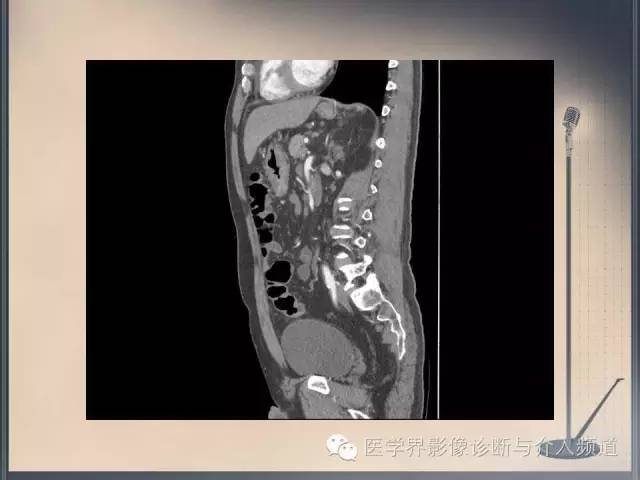 【病例】你以为这是肿瘤，其实这是鱼刺引发的“血案”！