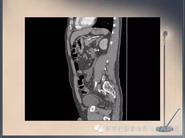 【病例】你以为这是肿瘤，其实这是鱼刺引发的“血案”！