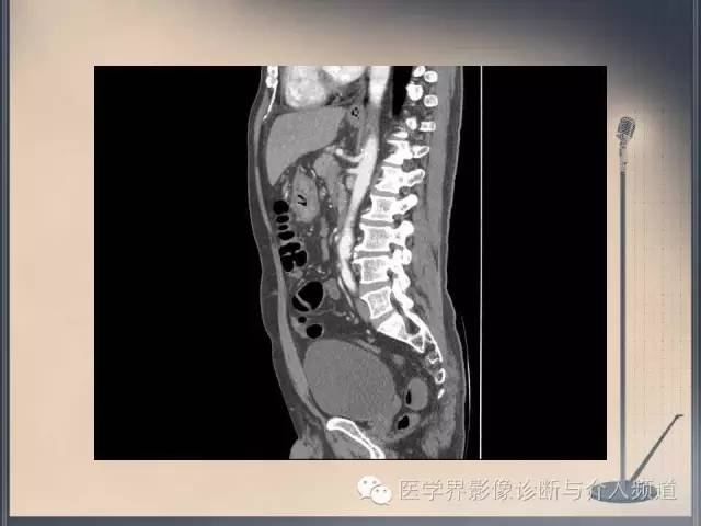 【病例】你以为这是肿瘤，其实这是鱼刺引发的“血案”！