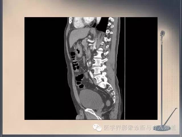 【病例】你以为这是肿瘤，其实这是鱼刺引发的“血案”！