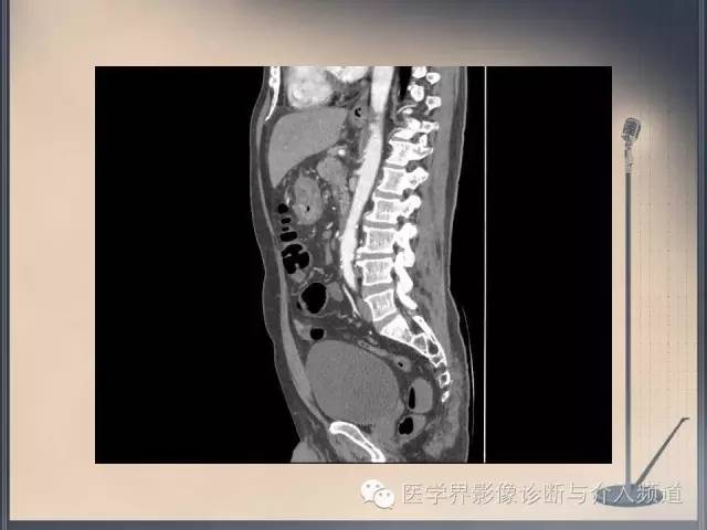 【病例】你以为这是肿瘤，其实这是鱼刺引发的“血案”！