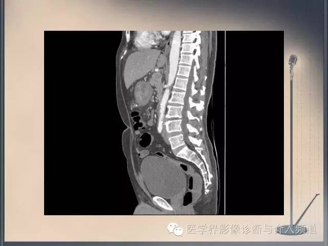 【病例】你以为这是肿瘤，其实这是鱼刺引发的“血案”！