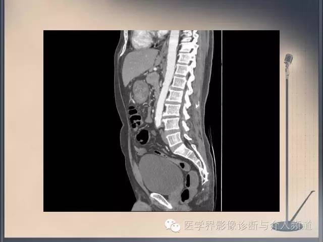 【病例】你以为这是肿瘤，其实这是鱼刺引发的“血案”！