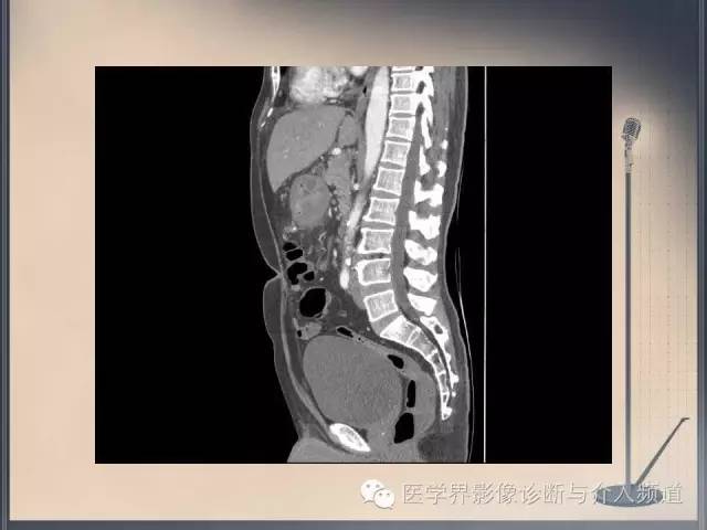 【病例】你以为这是肿瘤，其实这是鱼刺引发的“血案”！