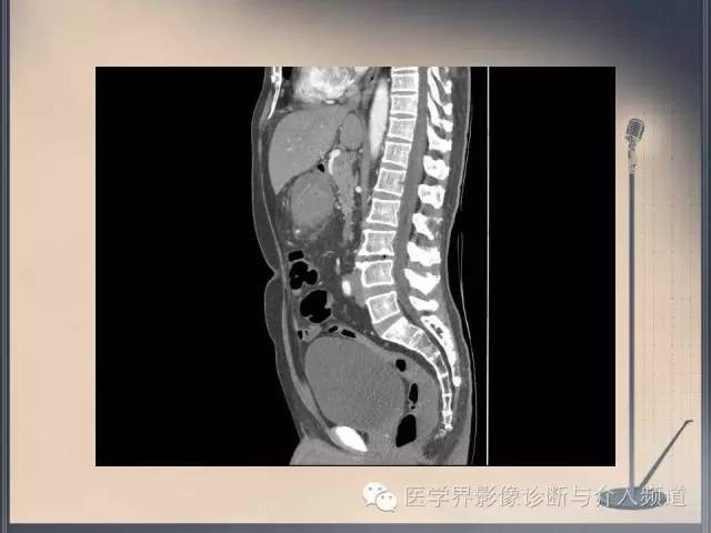 【病例】你以为这是肿瘤，其实这是鱼刺引发的“血案”！