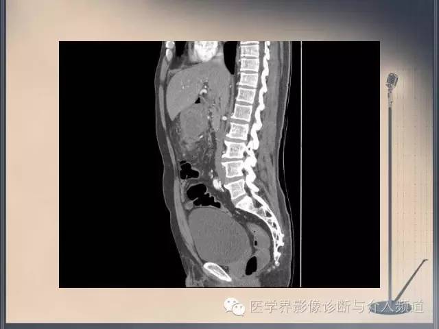 【病例】你以为这是肿瘤，其实这是鱼刺引发的“血案”！