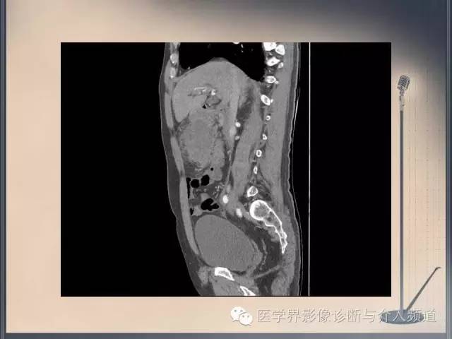 【病例】你以为这是肿瘤，其实这是鱼刺引发的“血案”！