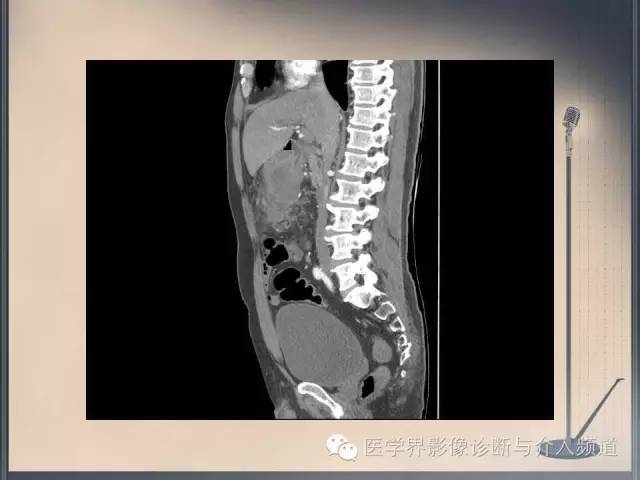 【病例】你以为这是肿瘤，其实这是鱼刺引发的“血案”！