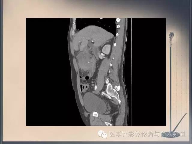 【病例】你以为这是肿瘤，其实这是鱼刺引发的“血案”！