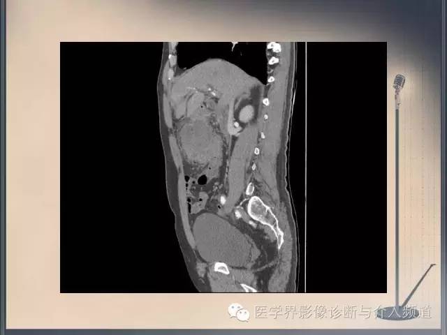 【病例】你以为这是肿瘤，其实这是鱼刺引发的“血案”！