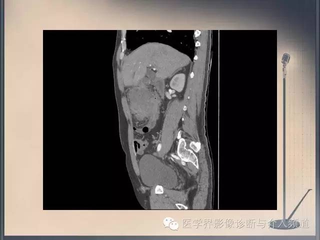 【病例】你以为这是肿瘤，其实这是鱼刺引发的“血案”！