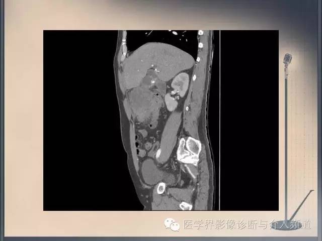 【病例】你以为这是肿瘤，其实这是鱼刺引发的“血案”！