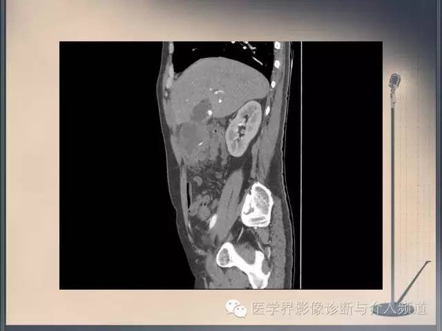 【病例】你以为这是肿瘤，其实这是鱼刺引发的“血案”！