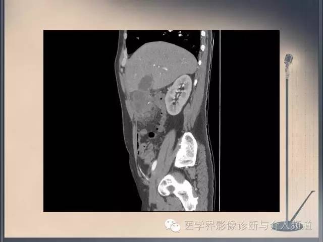 【病例】你以为这是肿瘤，其实这是鱼刺引发的“血案”！