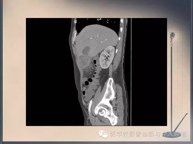 【病例】你以为这是肿瘤，其实这是鱼刺引发的“血案”！
