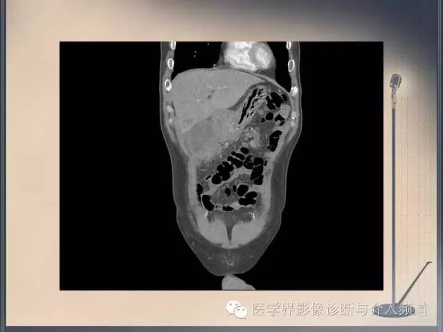【病例】你以为这是肿瘤，其实这是鱼刺引发的“血案”！