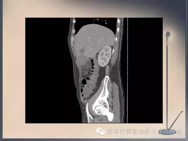 【病例】你以为这是肿瘤，其实这是鱼刺引发的“血案”！