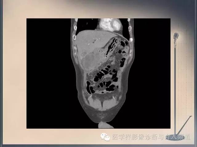 【病例】你以为这是肿瘤，其实这是鱼刺引发的“血案”！