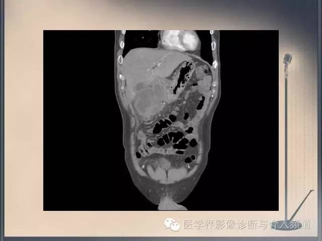 【病例】你以为这是肿瘤，其实这是鱼刺引发的“血案”！