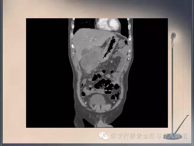 【病例】你以为这是肿瘤，其实这是鱼刺引发的“血案”！