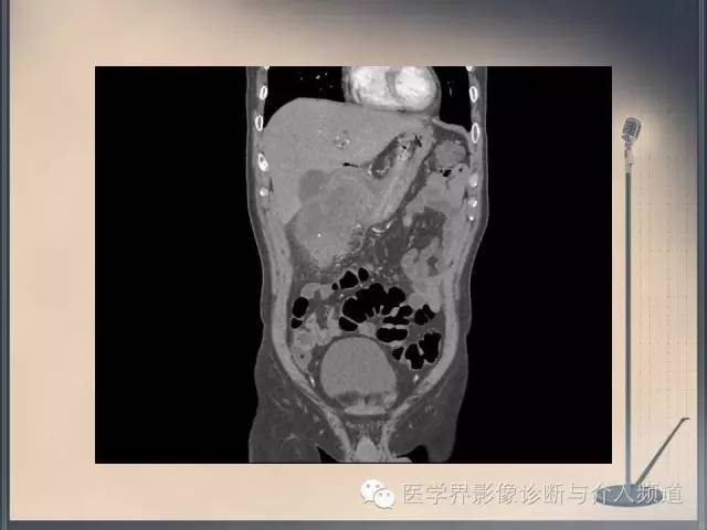 【病例】你以为这是肿瘤，其实这是鱼刺引发的“血案”！