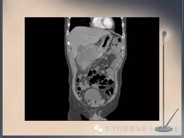 【病例】你以为这是肿瘤，其实这是鱼刺引发的“血案”！