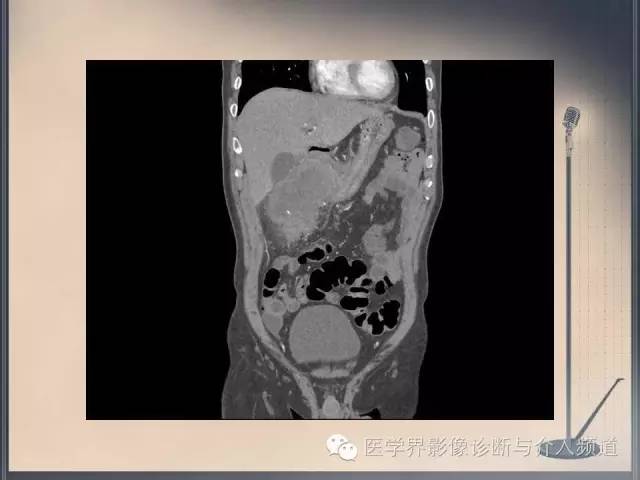 【病例】你以为这是肿瘤，其实这是鱼刺引发的“血案”！