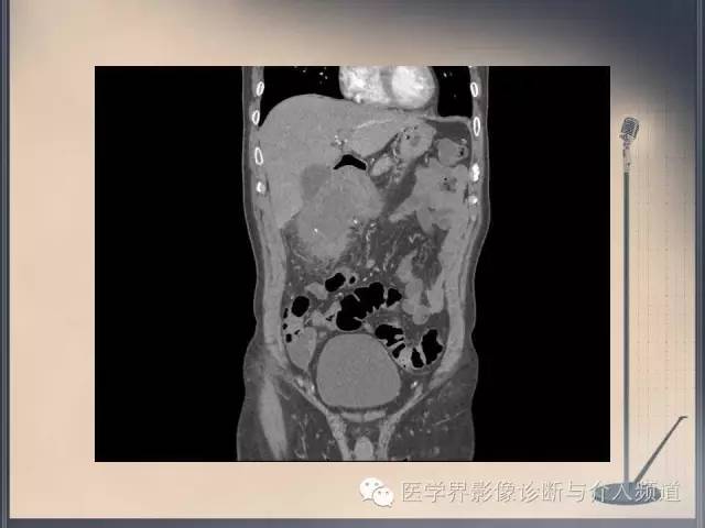 【病例】你以为这是肿瘤，其实这是鱼刺引发的“血案”！