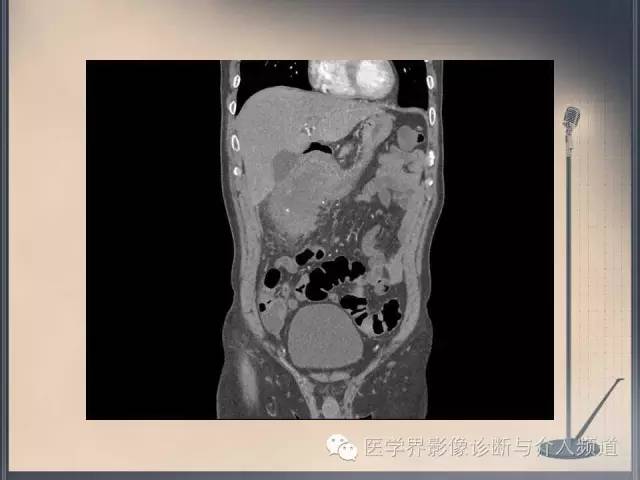 【病例】你以为这是肿瘤，其实这是鱼刺引发的“血案”！
