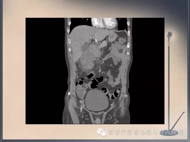 【病例】你以为这是肿瘤，其实这是鱼刺引发的“血案”！