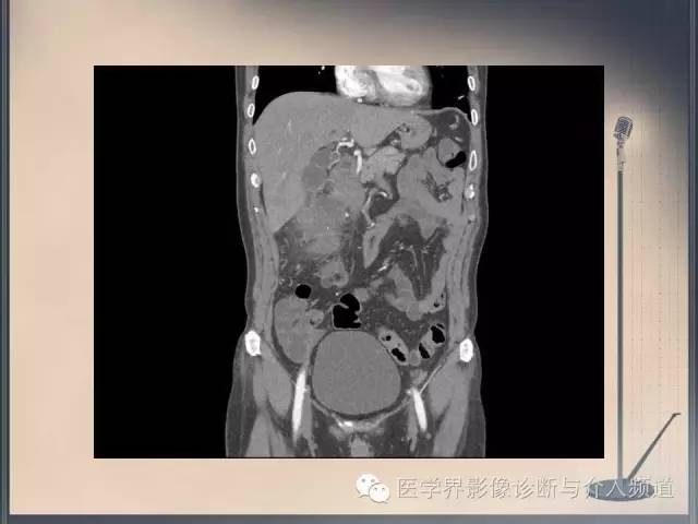 【病例】你以为这是肿瘤，其实这是鱼刺引发的“血案”！