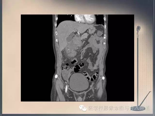 【病例】你以为这是肿瘤，其实这是鱼刺引发的“血案”！