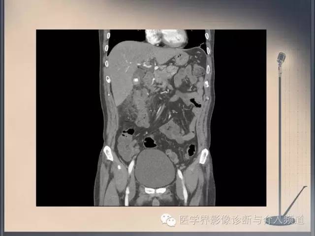 【病例】你以为这是肿瘤，其实这是鱼刺引发的“血案”！