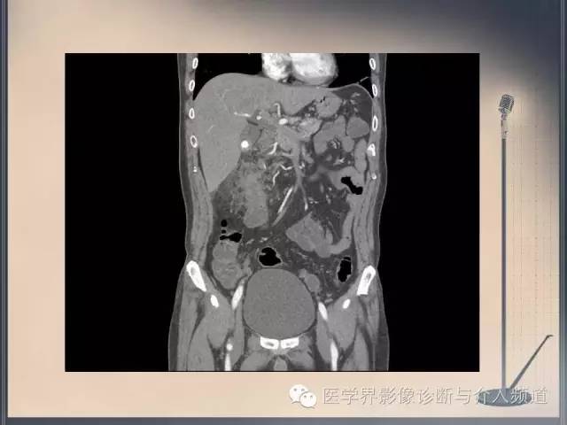 【病例】你以为这是肿瘤，其实这是鱼刺引发的“血案”！