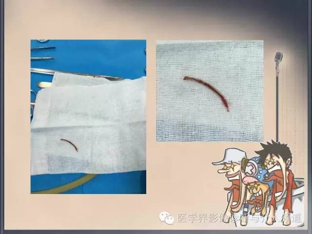 【病例】你以为这是肿瘤，其实这是鱼刺引发的“血案”！