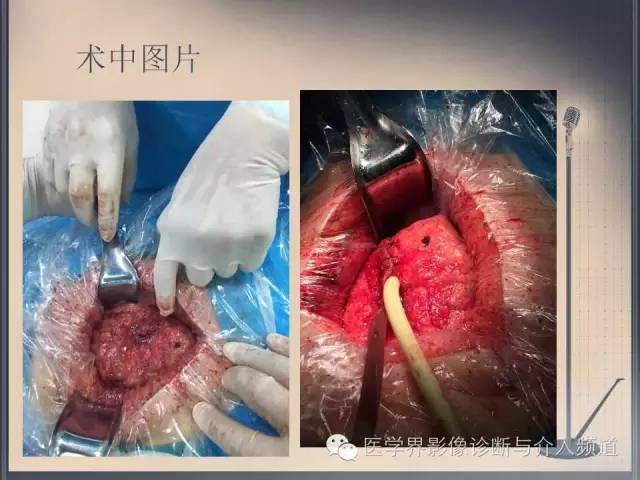 【病例】你以为这是肿瘤，其实这是鱼刺引发的“血案”！