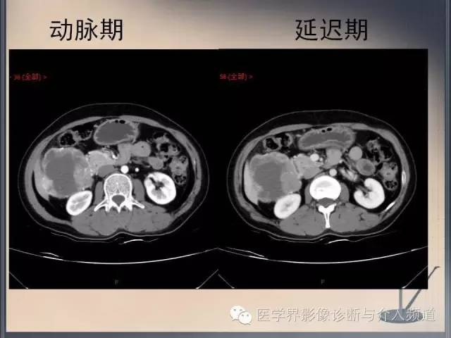 【病例】你以为这是肿瘤，其实这是鱼刺引发的“血案”！