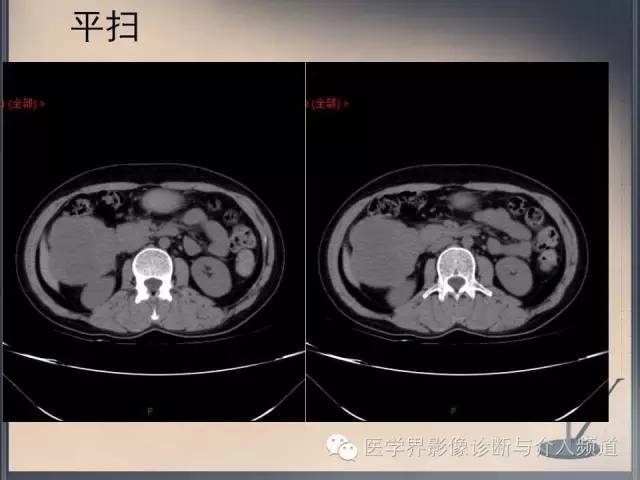 【病例】你以为这是肿瘤，其实这是鱼刺引发的“血案”！