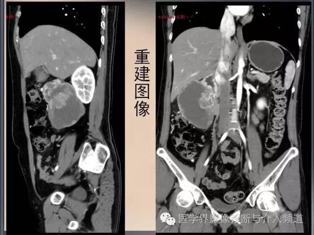 【病例】你以为这是肿瘤，其实这是鱼刺引发的“血案”！