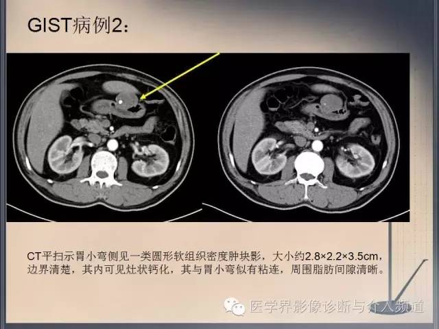【病例】你以为这是肿瘤，其实这是鱼刺引发的“血案”！