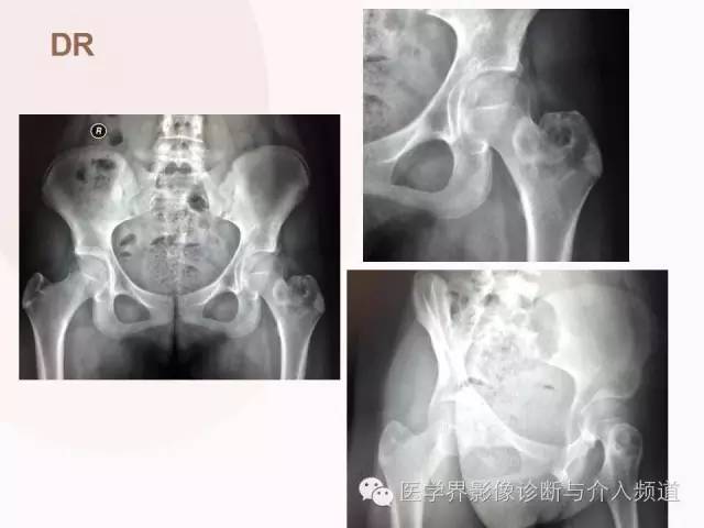 【病例】软骨母细胞瘤2例影像表现与鉴别